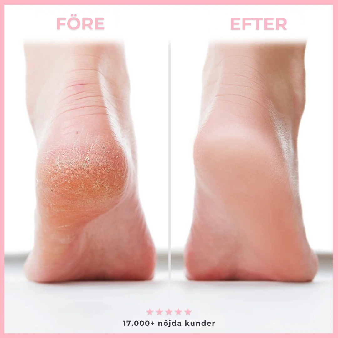 Nirelle FootShine™ - Mjuka och fina fötter på nolltid